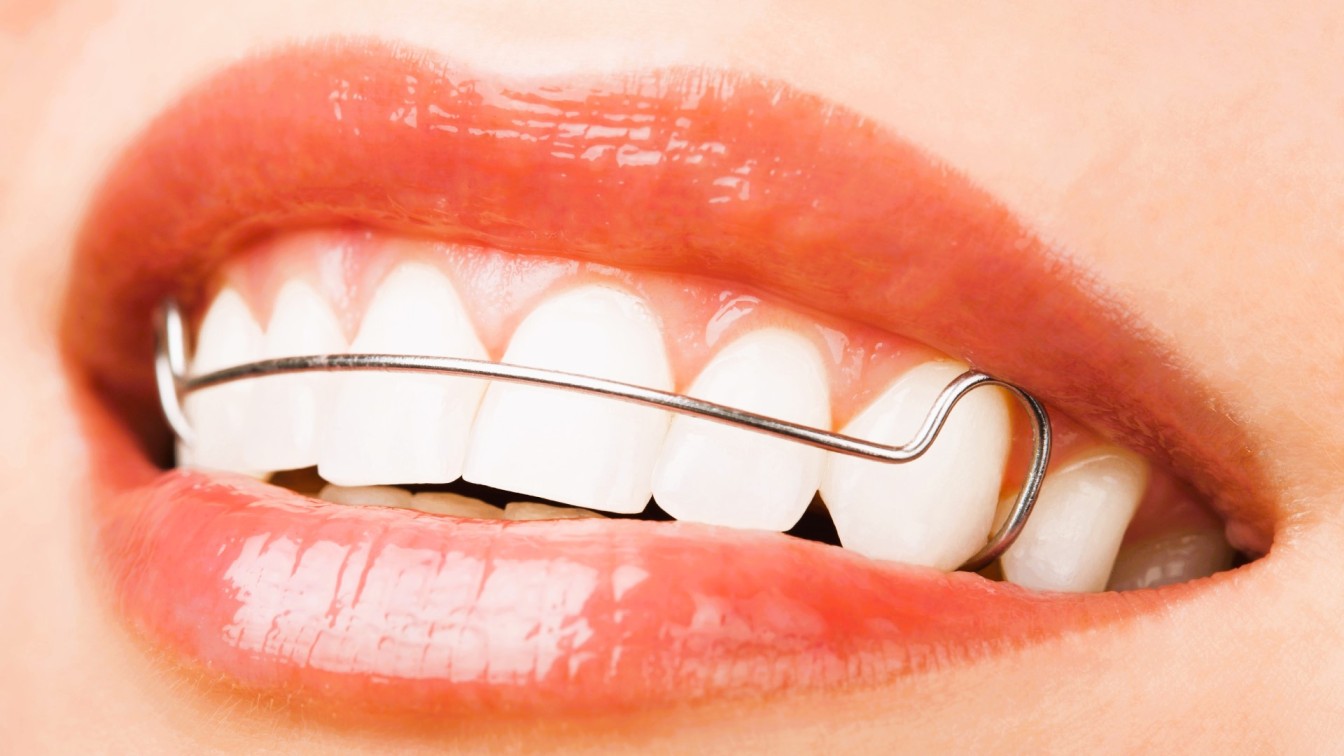 Retainers-Orthodontist-USA (1)