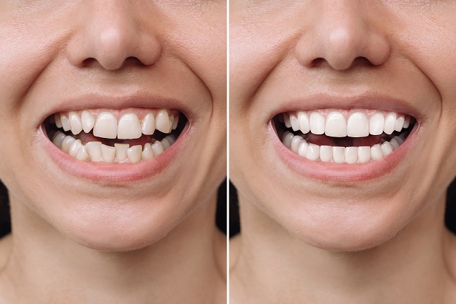 Cropped,Shot,Of,A,Young,Caucasian,Smiling,Woman,Before,And