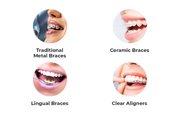 types of braces-orthodontistusa