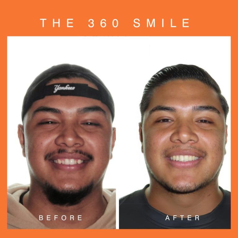 teeth before after a 768x768